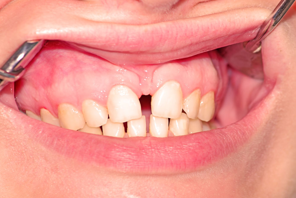 diastema