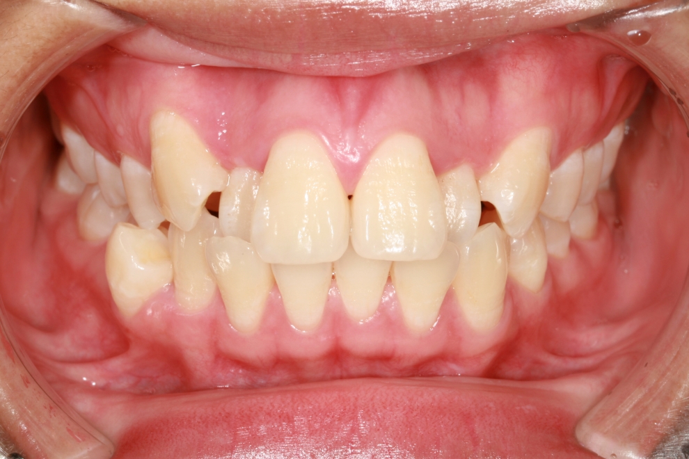 dientes apiñados