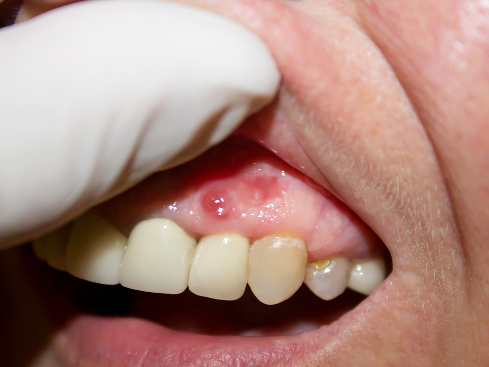 abceso dental