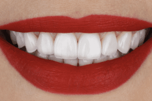 Cuidado de las carillas dentales: consejos prácticos