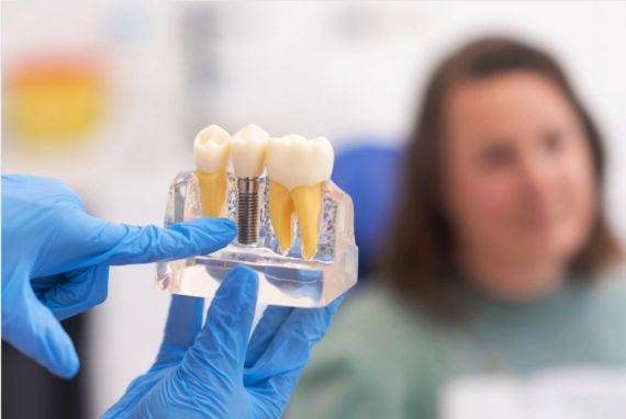 Cómo cuidar tus implantes dentales