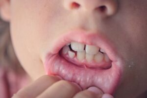 Frenillo labial inferior