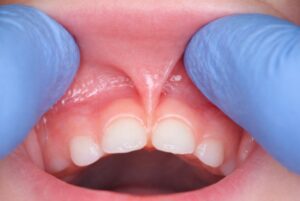 Frenillos en bebés y niños