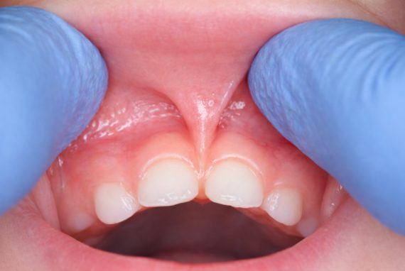 Frenillos en bebés y niños