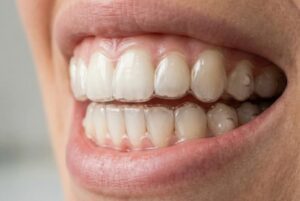 Mordida descompensada en adultos: cuándo es un problema funcional y no solo estético