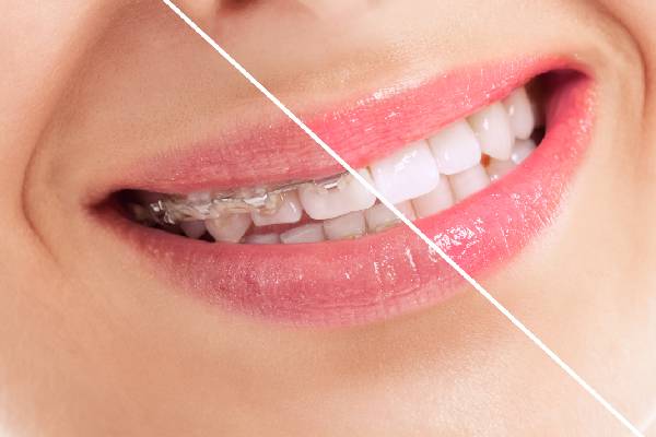 Ortodoncia para mejorar tu estética y salud bucodental