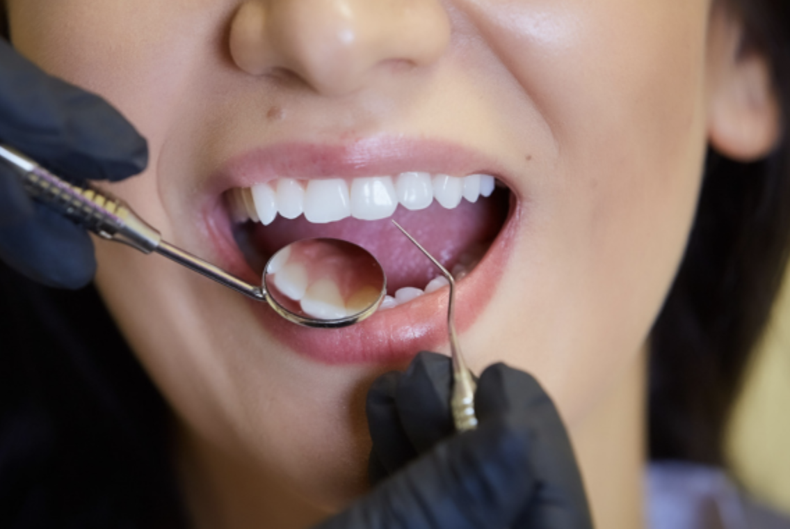 Por qué son tan importantes las revisiones dentales