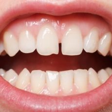 diastema