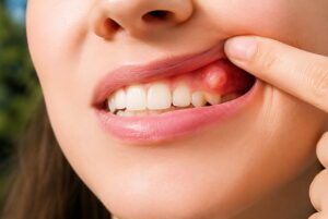 quiste dental