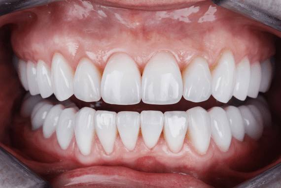 Rejuvenecimiento dental