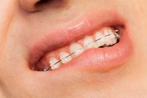 Dientes torcidos